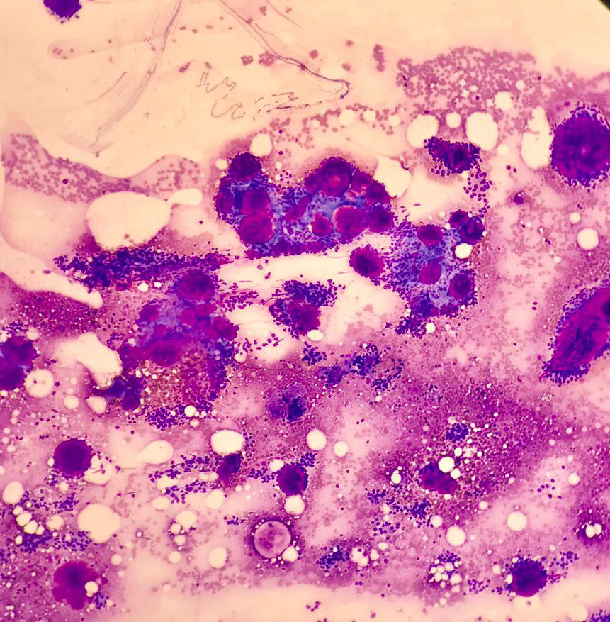 Citopatología y punción aspiración con aguja fina (PAAF) en consulta
